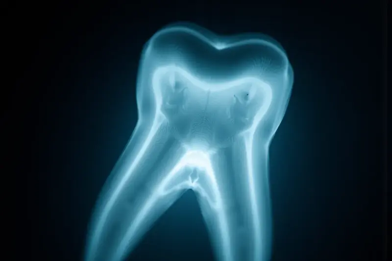 Jak wygląda ząb do leczenia kanałowego na RTG?